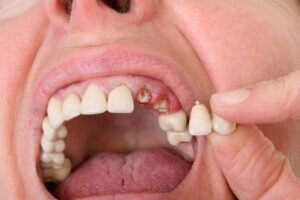 Giải mã giấc mơ rụng răng: Ý nghĩa tâm linh và tâm lý đằng sau