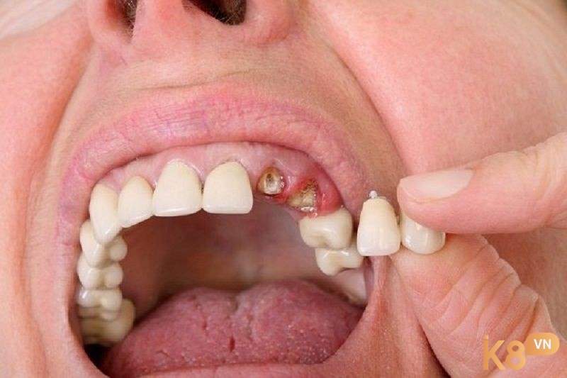 Ý nghĩa giấc mơ rụng răng chi tiết nhất tại K8